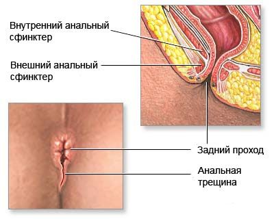 Anal fissure 
