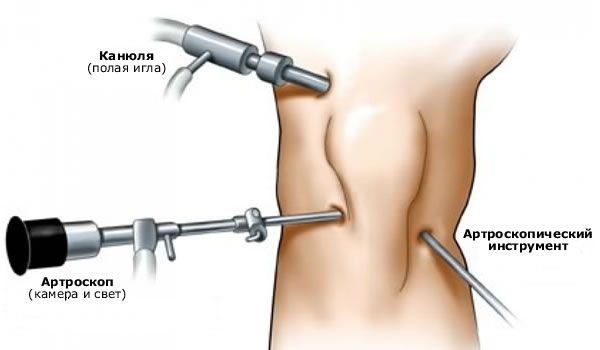 Arthroscopy of the knee joint