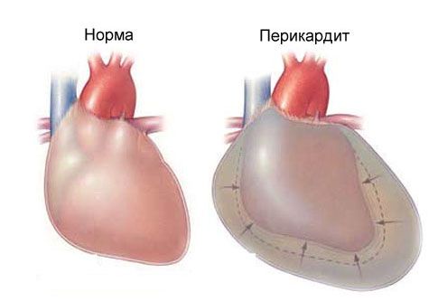 Acute pericarditis and chest pains on the left