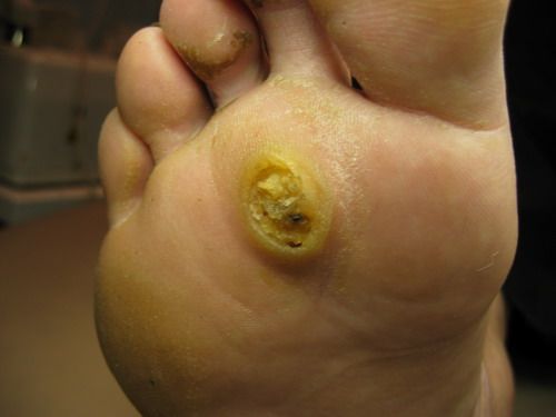 Cause of warts on the legs