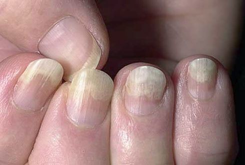 Peeling of the nail plate from soft tissues