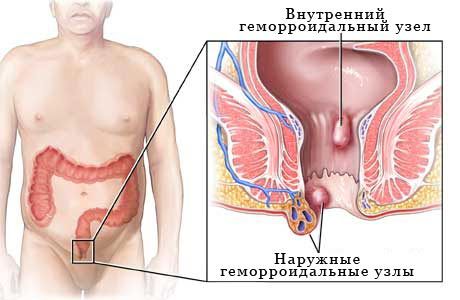 Prevalence of hemorrhoids