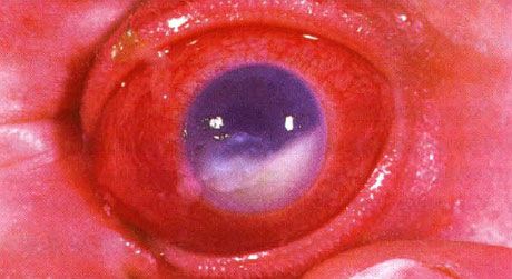 Hypopyon accompanying endophthalmitis