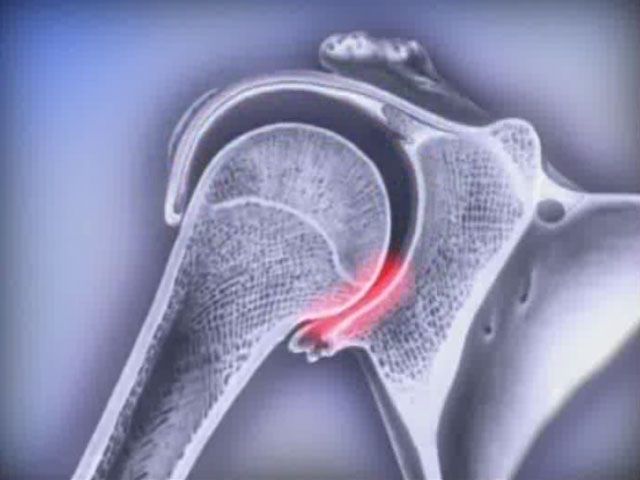 What is a dislocation? 