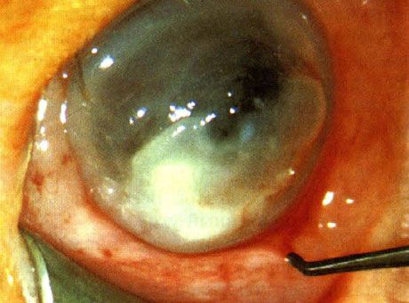 Pseudomonas keratitis in a newborn. No predisposing factors identified