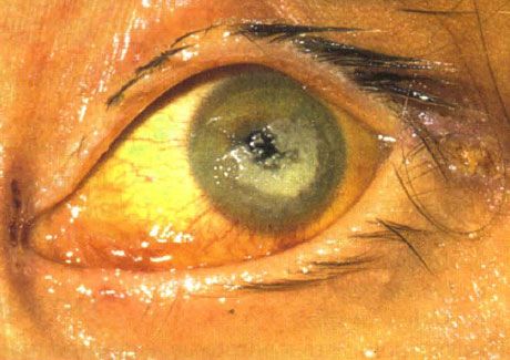 Bilateral Candida keratitis in a severely immunocompromised child