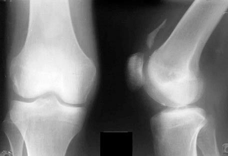 Roentgen of the knee joint