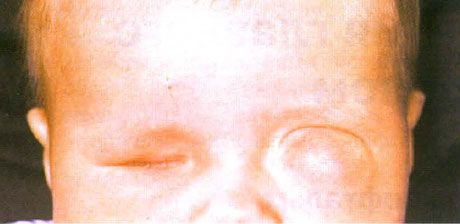 Microphthalmos with associated cyst formation (left eye). Anophthalmos (right eye).