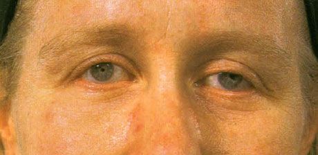 Bilateral microphthalmos without associated colobomas, in adulthood