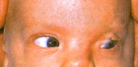 Fraser syndrome. Incomplete cryptophthalmos of the left eye.