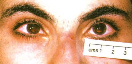 Nanoftaplm. Eyes are reduced in size.
