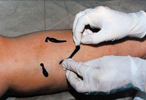 Leeches against varicose veins