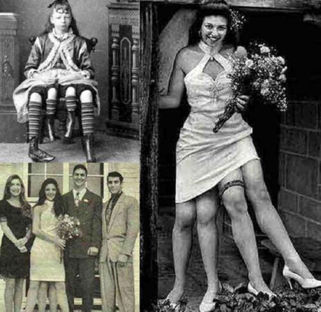 The Most Famous Mutants - The Girl With Four Legs
