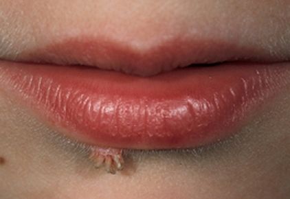 Filiform warts