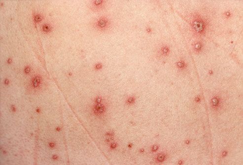 Chickenpox/varicella