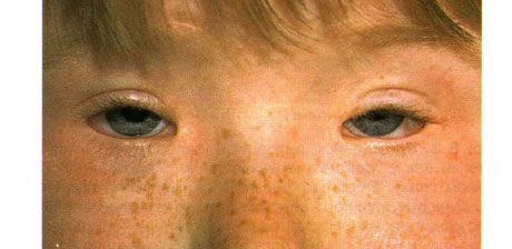 Syndrome of blepharophimosis.  Two-sided operated ptosis, telecanthus and blepharophimosis