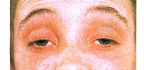 External ophthalmoplegia.  Two-sided ptosis.  The patient opens his eyes by raising his eyebrows
