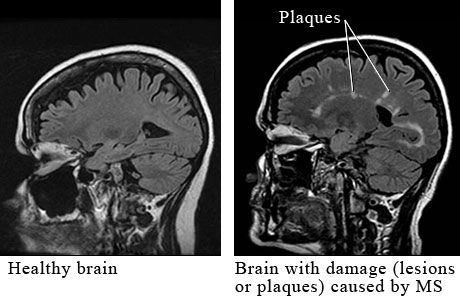 Multiple sclerosis can be cured