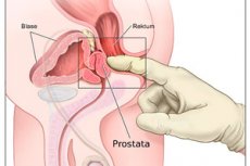 masaj prostatei forum prostatita