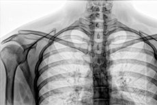 Clavicle X-ray: projections, norm, description