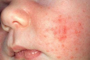 Erythema of newborns: toxic and physiological | Competently about ...