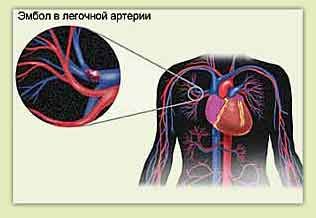 Pulmonary embolism and chest pains on the left