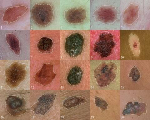 Scientists have found a gene that plays a central role in the development of melanoma