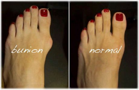 Why and how does the foot suffer from overload?