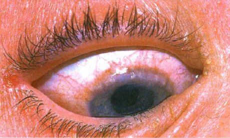 Lumbar spring conjunctivitis.  Tratas spots are visible