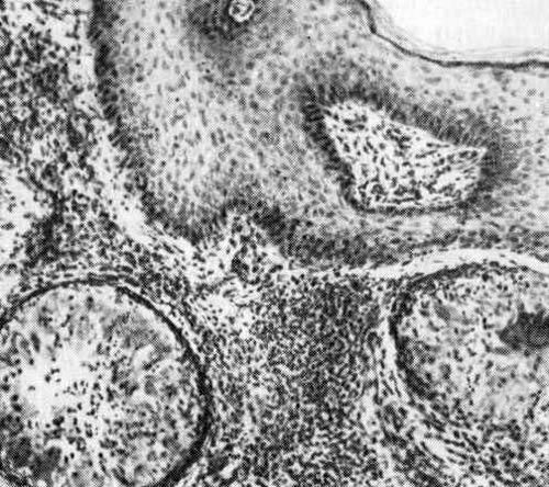 Chromoblastomycosis pathogens